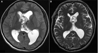 Single-Center Retrospective Analysis of Risk Factors for Hydrocephalus After Lateral Ventricular Tumor Resection